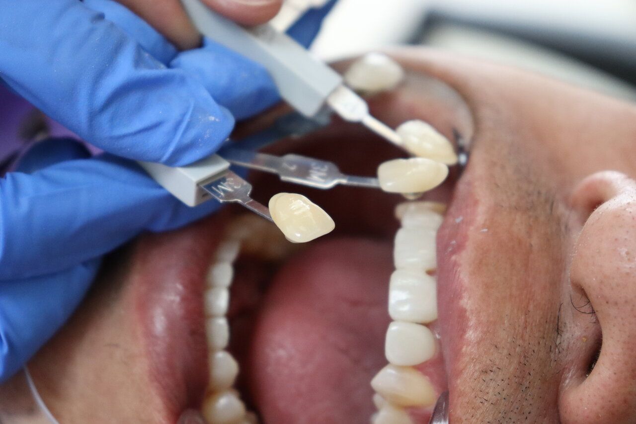 a man is getting dental veneers applied to his teeth by a dentist.