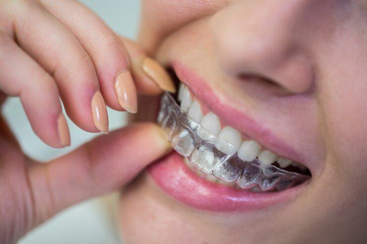 A woman is putting a clear Invisalign aligner on her teeth.
