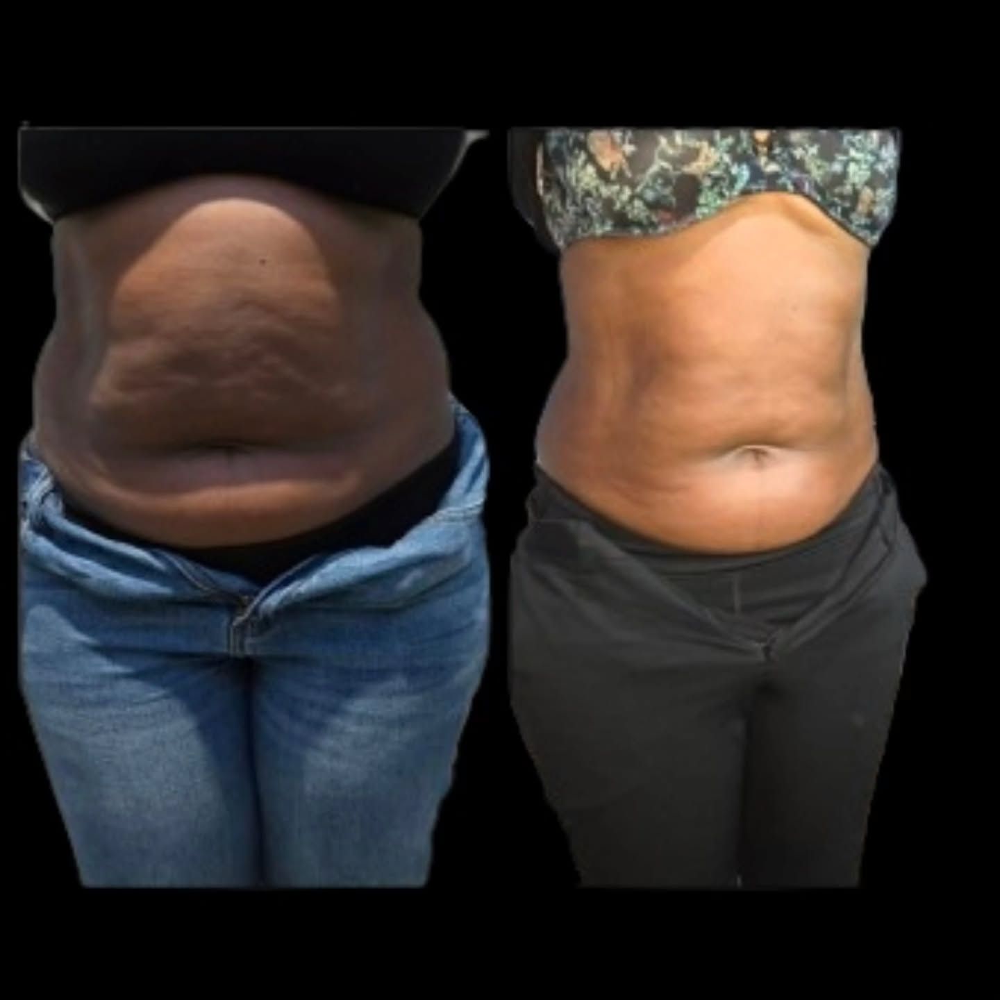 Before and after photos of a person's midsection, showing reduction in abdominal fat.
