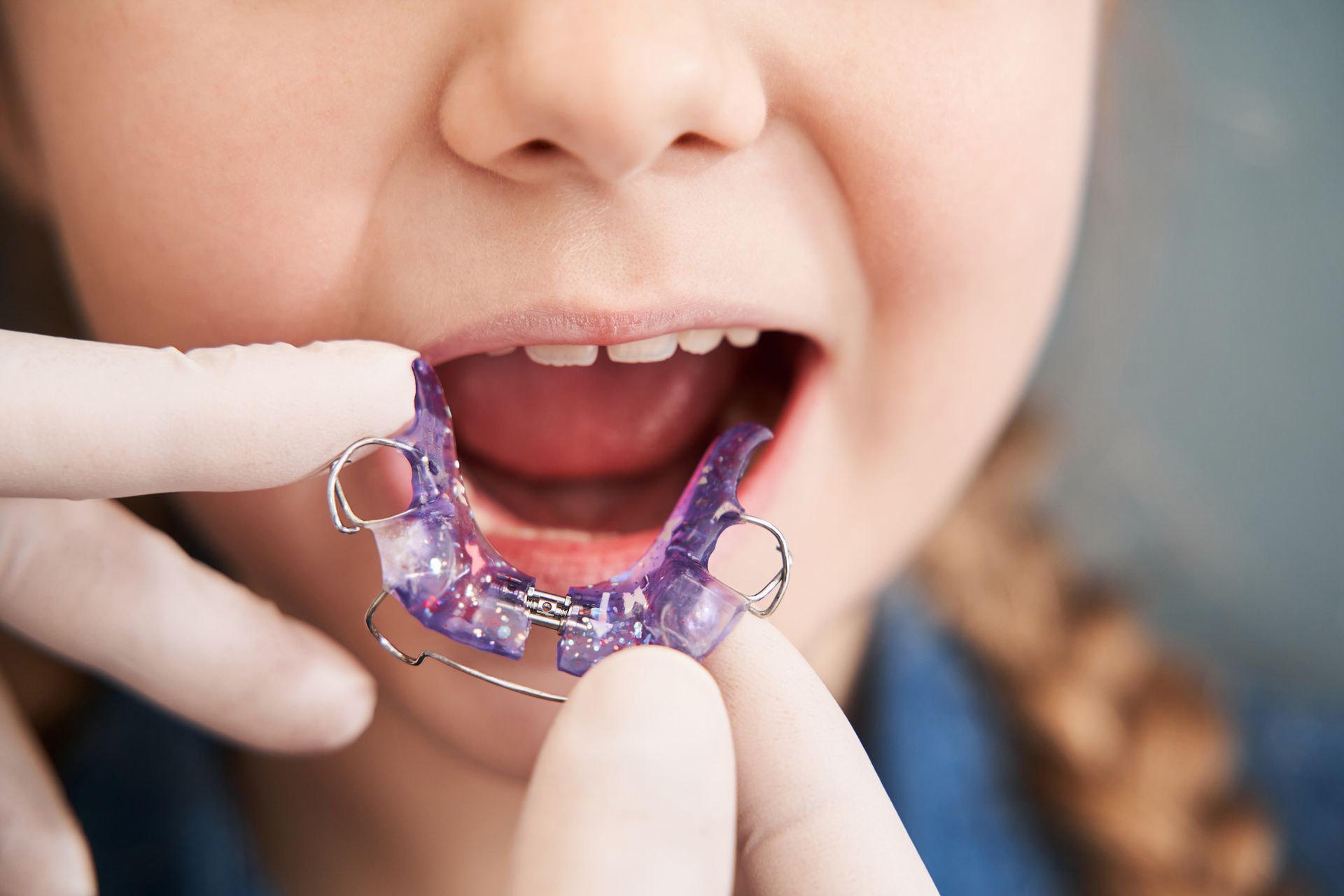 Close-up of a child with an open mouth as someone inserts a purple retainer.