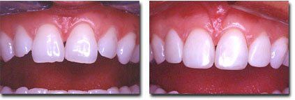 Before and After Cosmetic Work — Westlake, OH — Aico’s Dental Group