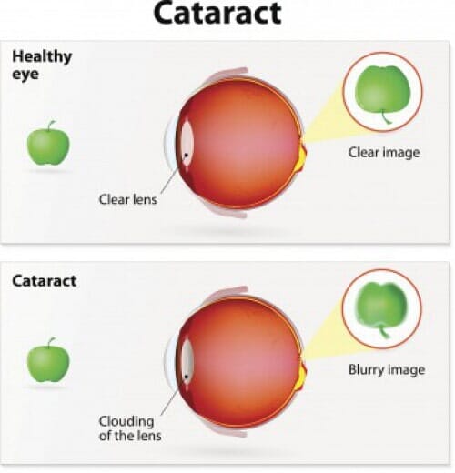 Cataract Diagram-Suncoast Eye Center and Eye Surgery Institute in Hudson, FL