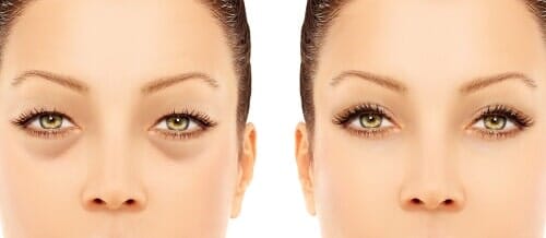 Before and After of Eyelid Surgery - Suncoast Eye Center and Eye surgery Institute- Hudson, FL