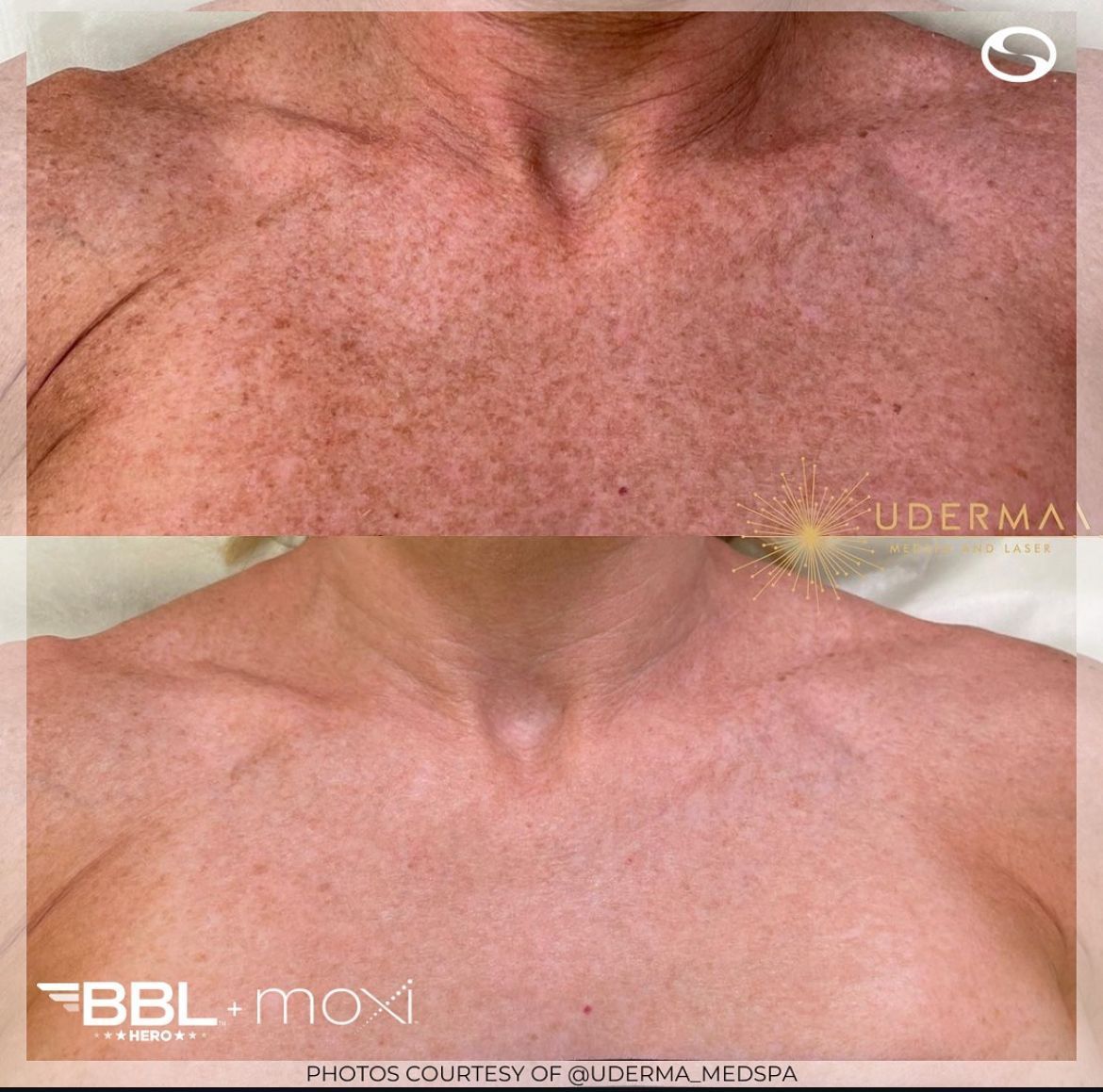 Before and after images of a chest area showing reduced skin pigmentation after BBL and Moxi laser treatments.