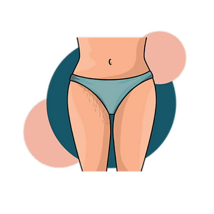A cartoon illustration of a woman 's legs with stretch marks.