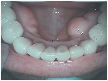 After Orthodontics Process — Redding, CA — Robert L Dague, DDS