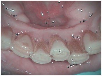 Before Orthodontics Process — Redding, CA — Robert L Dague, DDS