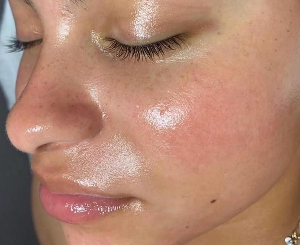 Eine Nahaufnahme des Gesichts einer Frau mit geschlossenen Augen nach Behandlung Hydrafacial.