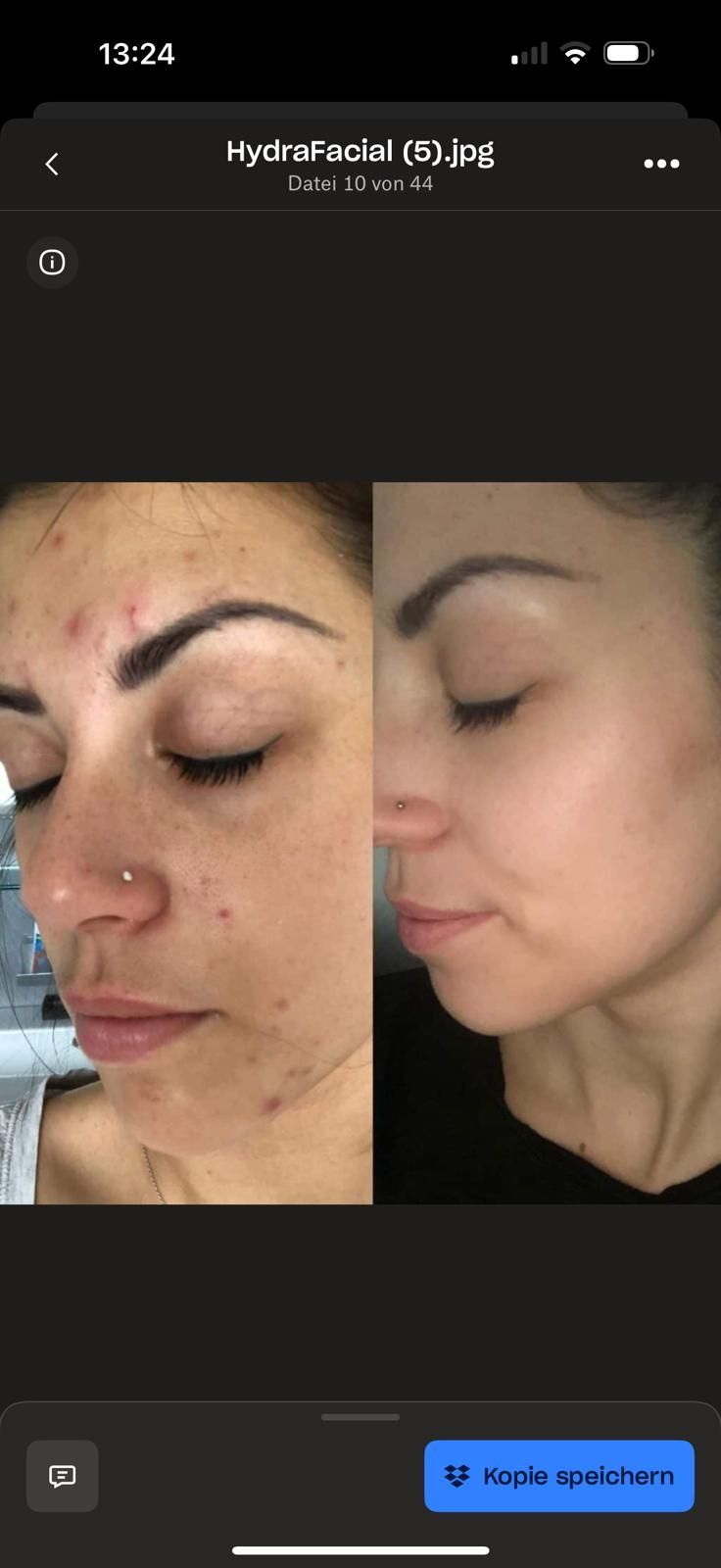 Ein Vorher-Nachher-Bild des Gesichts einer Frau mit Akne.