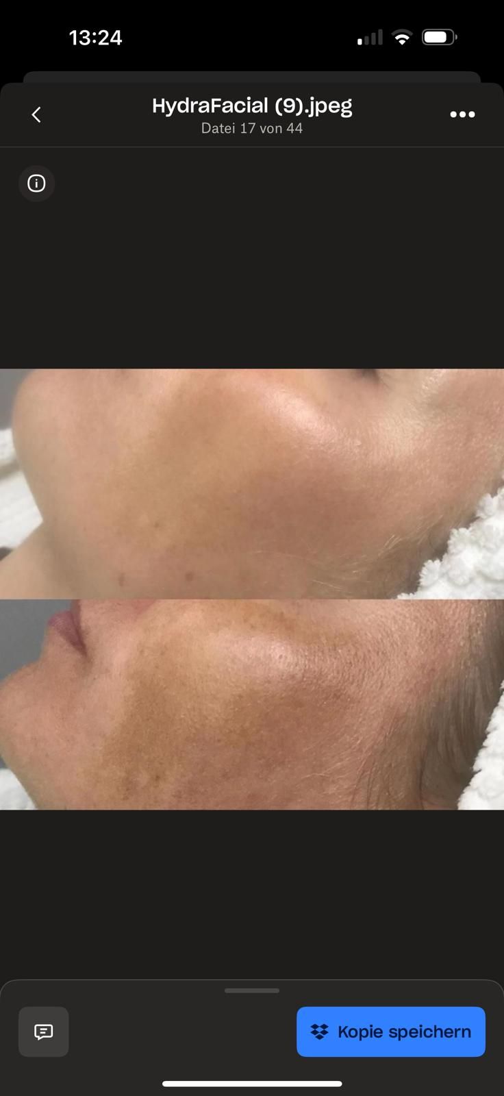 Ein Vorher-Nachher-Bild des Gesichts einer Frau mit Akne.