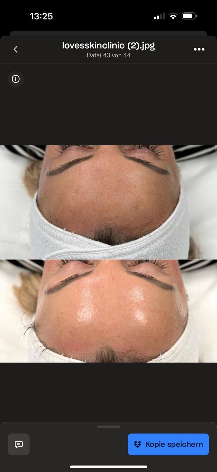 Ein Vorher-Nachher-Foto vom Gesicht einer Frau mit Akne.