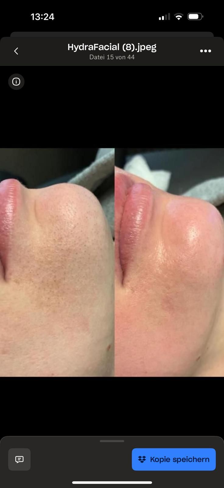 Ein Vorher-Nachher-Foto vom Gesicht einer Frau mit Akne.