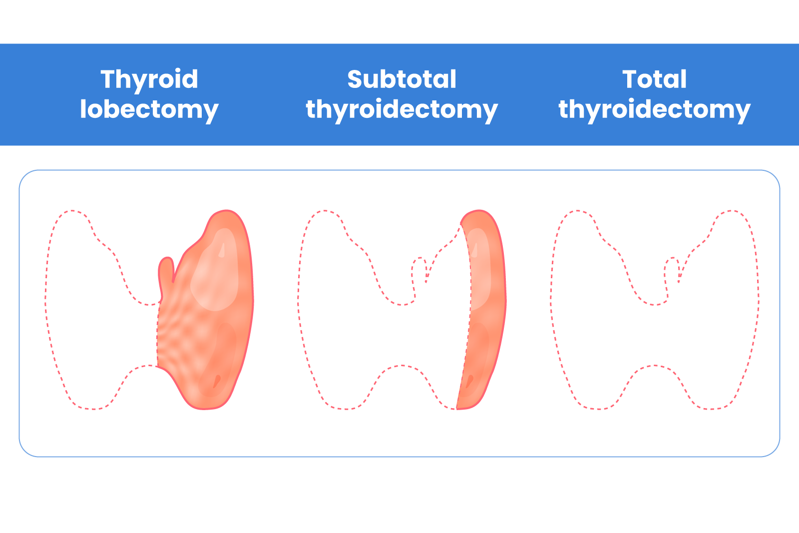 Types of Thyroidectomy