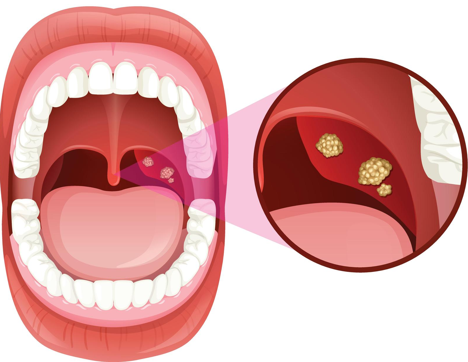 a cartoon illustration of a person 's mouth with a sore throat .
