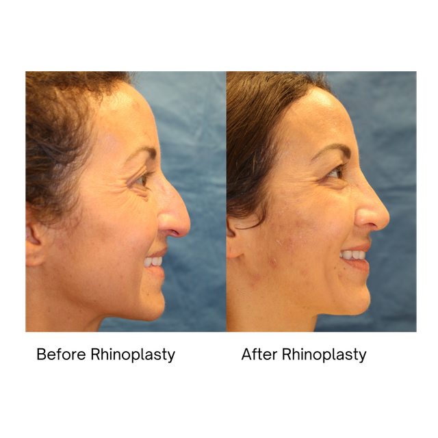 Rhinoplasty Austin Tx