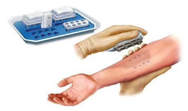 Allergy Skin Testing — Centro de Neumologia Pediatrica