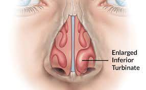 Turbinate Reduction