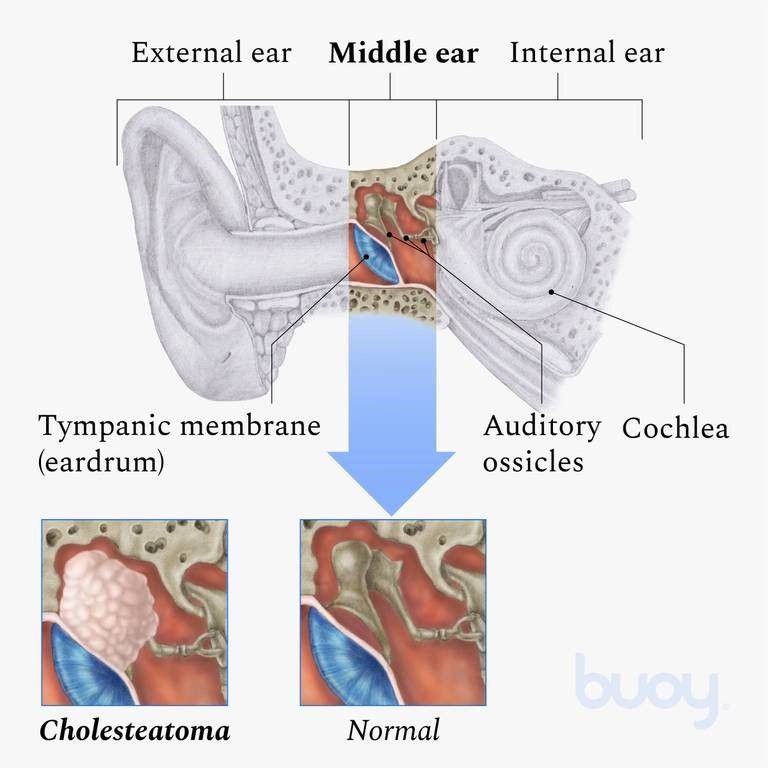 An illustration of an ear with cholesteatoma