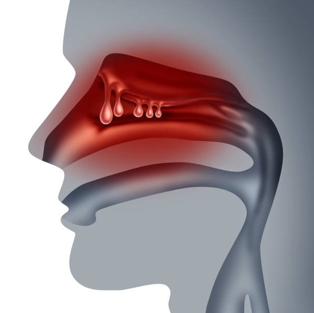 Sinusitis