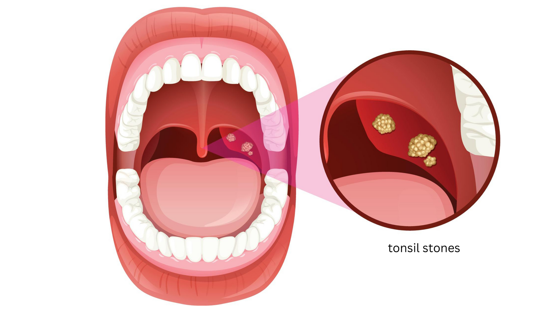 A cartoon illustration of a person 's mouth with tonsils.