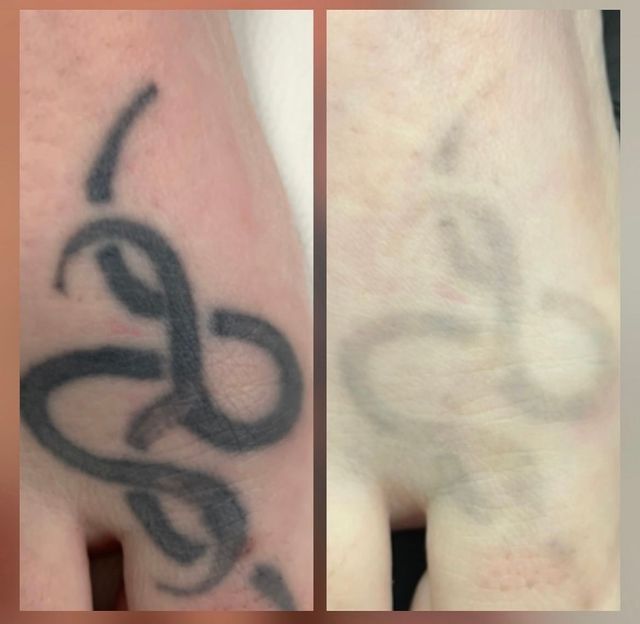 Laser removal for tattoos in Wellingborough