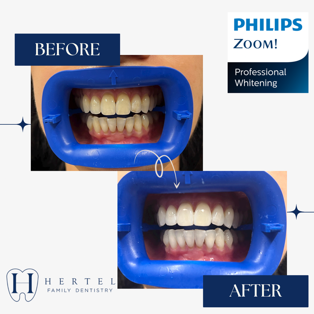 Professional Whitening - Buffalo, NY - Hertel Family Dentistry