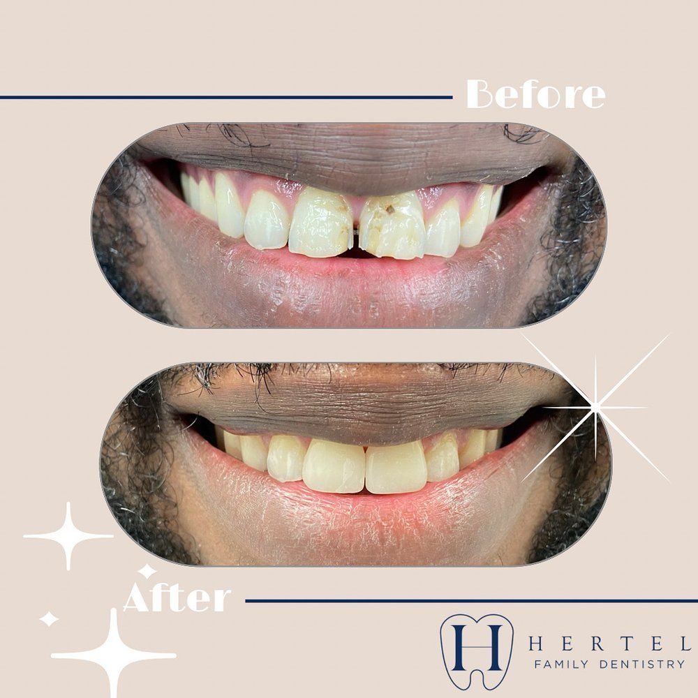  Before and After Photo of a Man 's Teeth by Hertel Family Dentistry - Buffalo, NY - Hertel Family Dentistry