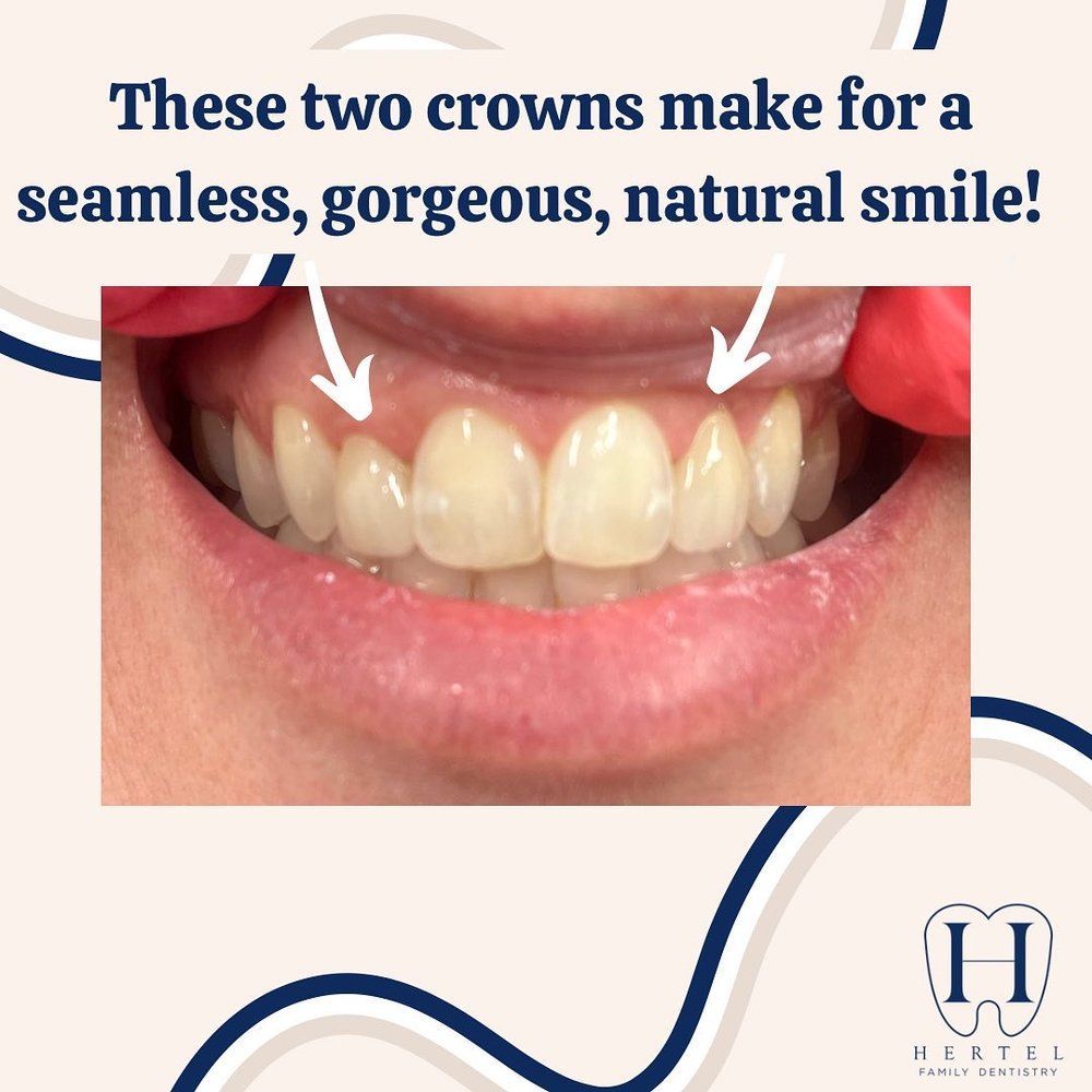 These Two Crowns Make for a Seamless, Gorgeous, Natural Smile - Buffalo, NY - Hertel Family Dentistry