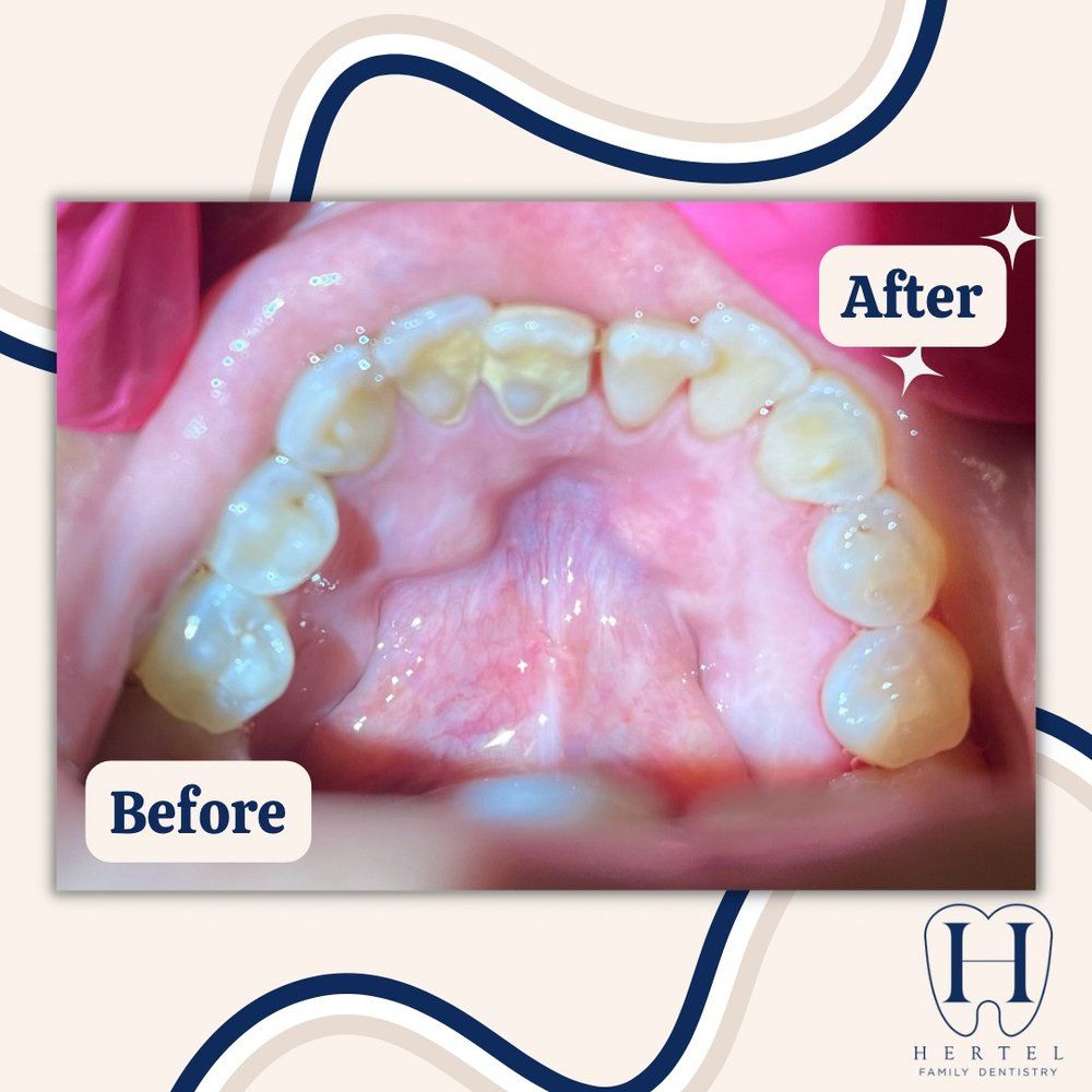 Teeth - Buffalo, NY - Hertel Family Dentistry