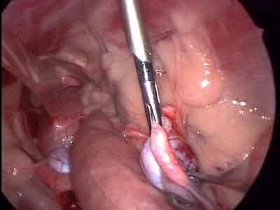 chirurgia testicoli