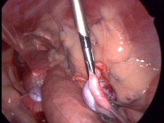 criptorchismo criptorchismo