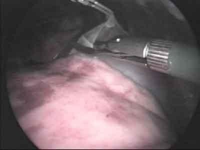 chirurgia pericardio