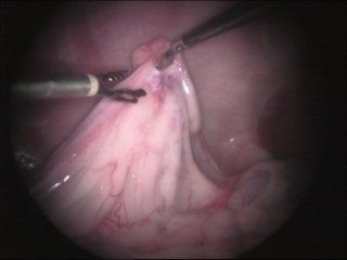 ovariectomia ovariectomia