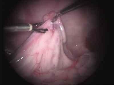 chirurgia ovaie