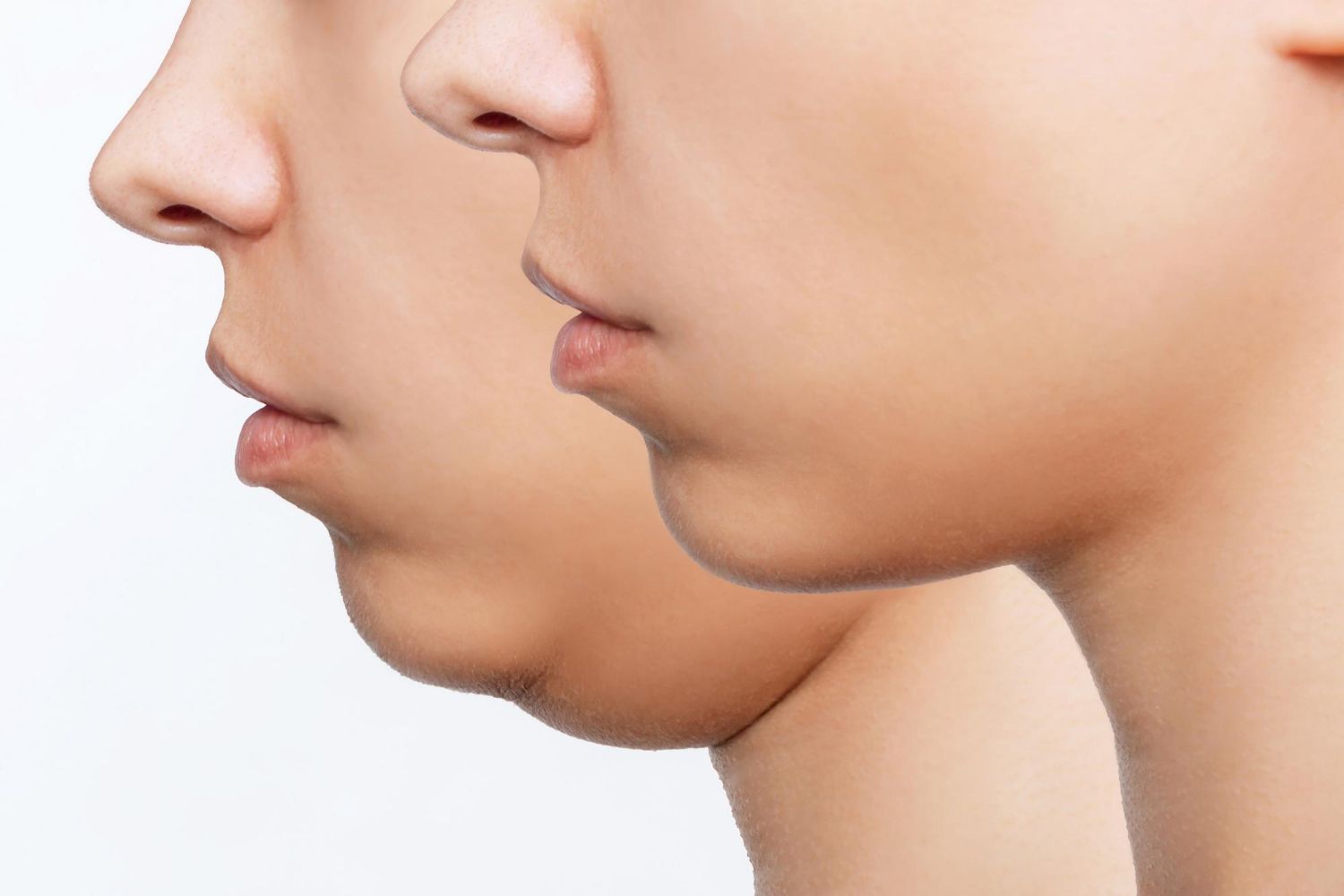 Profile view of a face before and after a cosmetic procedure, showing a reduction in a double chin.