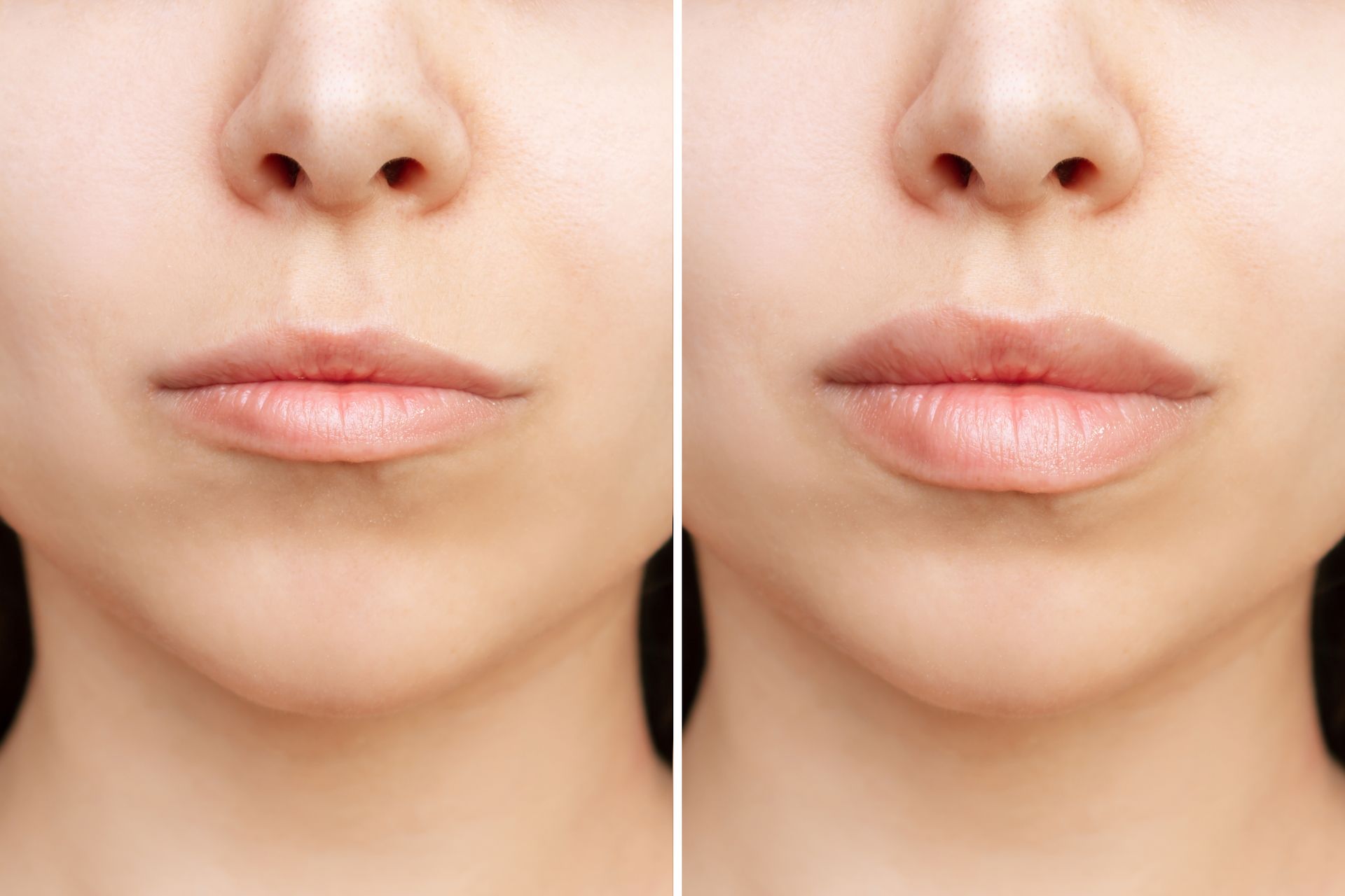 filler removal before after