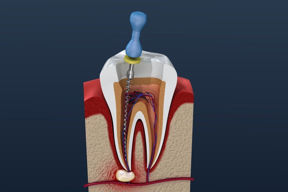 Root Canal Treatment | Sparwood Dental Clinic