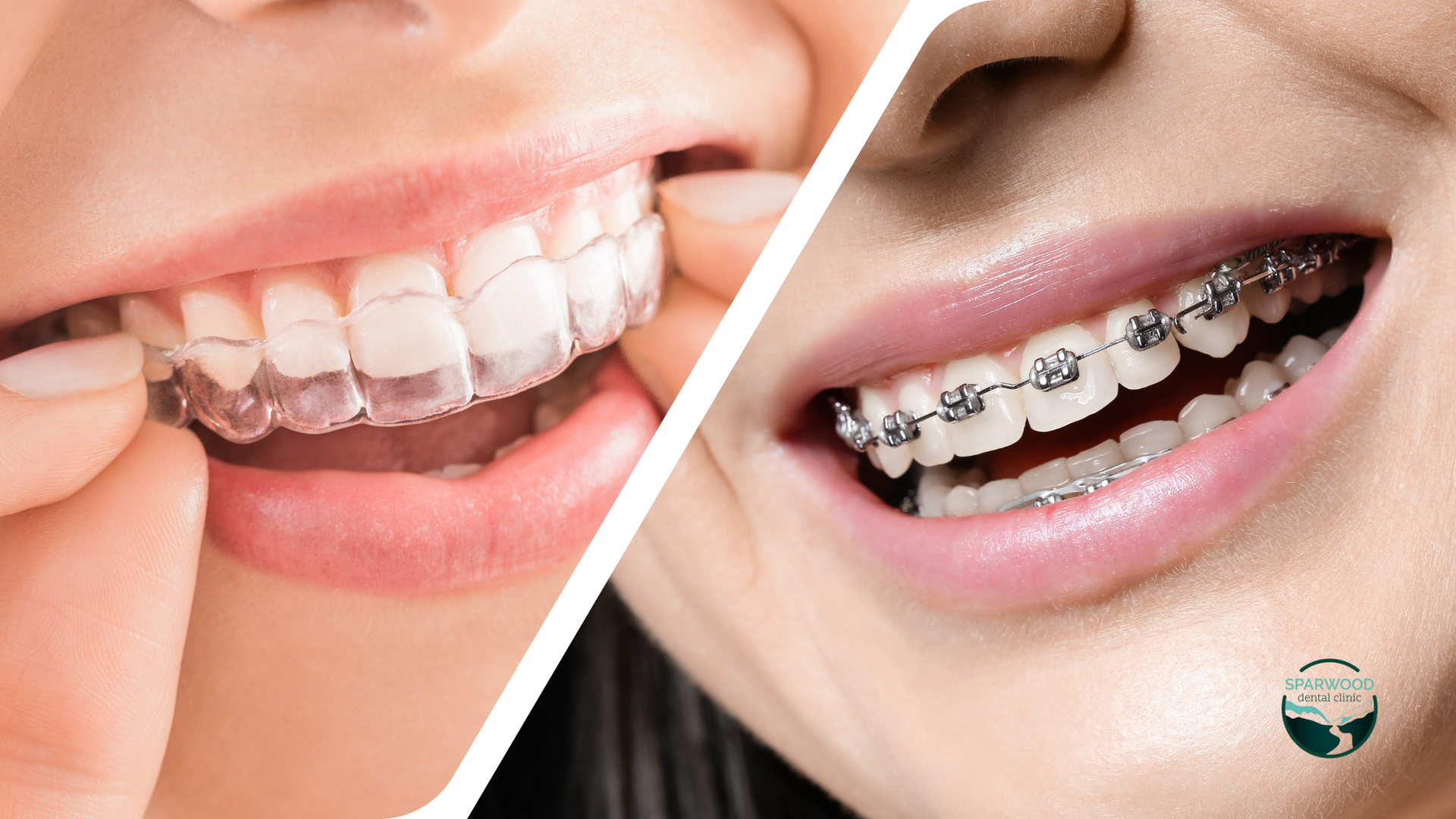 A woman with braces on her teeth and a woman with clear braces on her teeth.