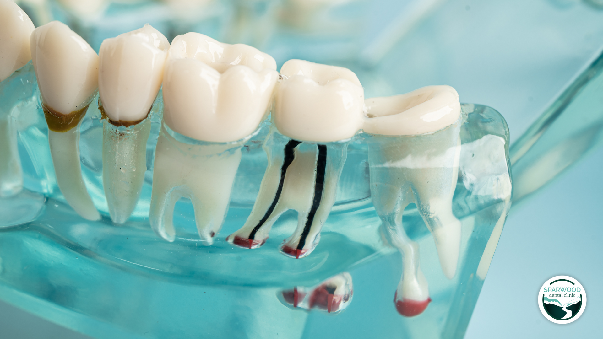 Dental model showing teeth, one with a root canal, in a clear jaw.