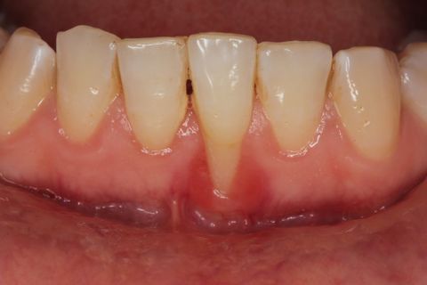Gum Disease | Sparwood Dental Clinic