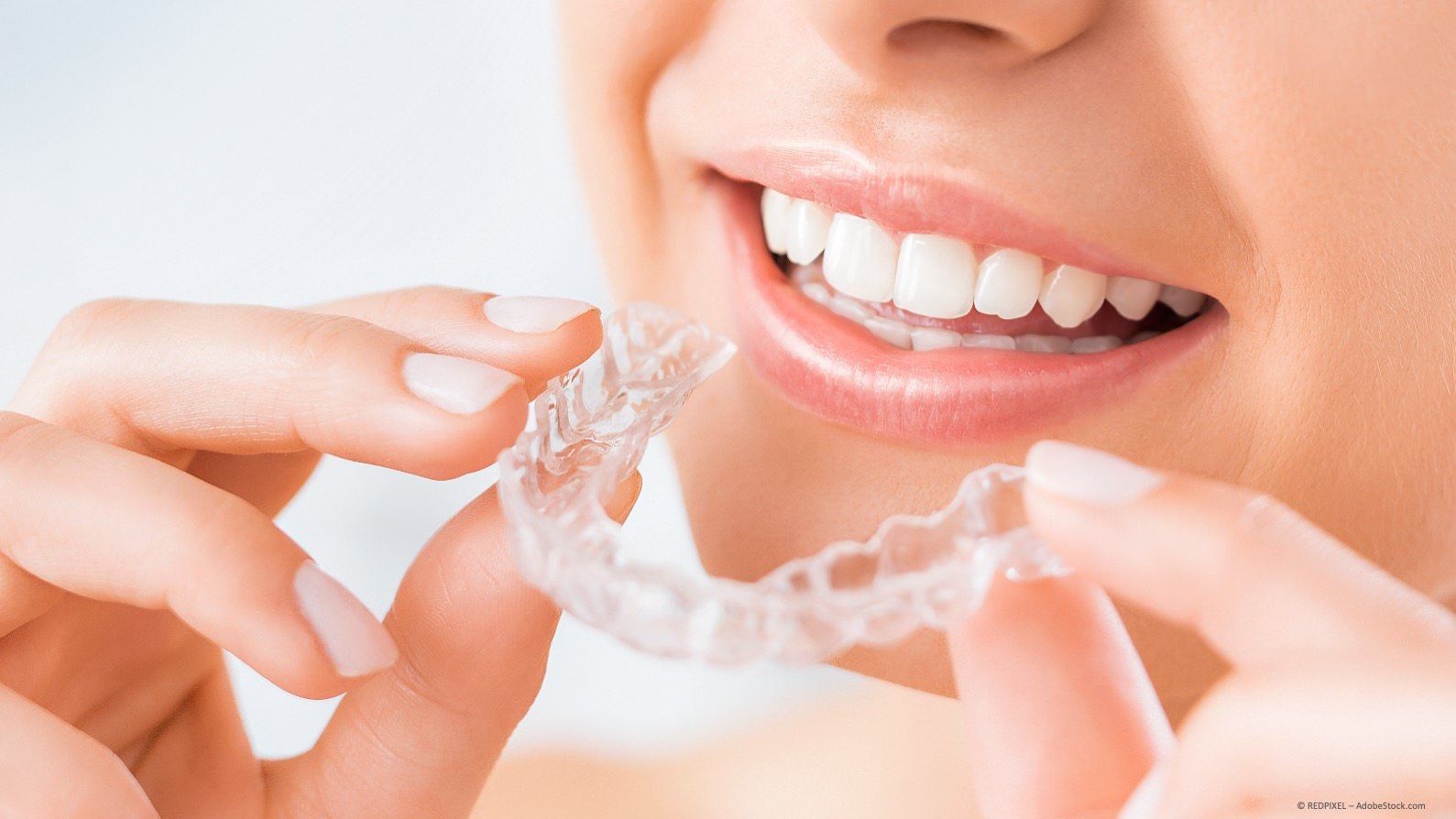 Aligner: die moderne und bequeme Art der Zahnregulierung