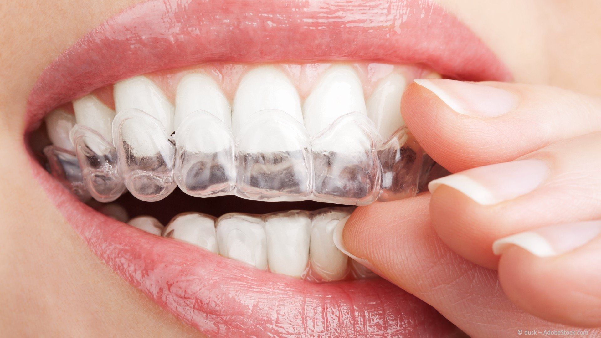 Aligner: transparente Folien zur Zahnregulierung