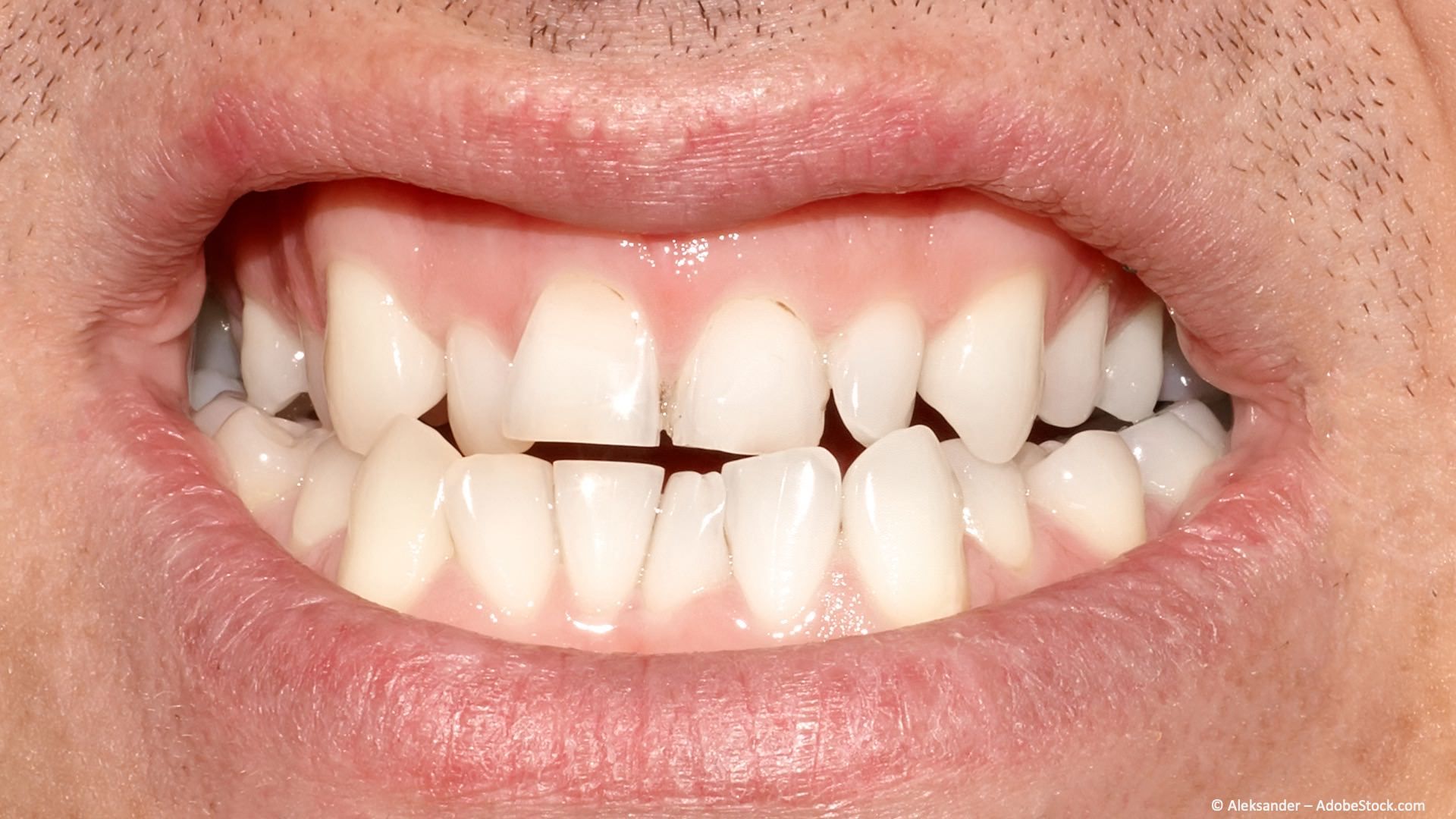 Zahn- und Kieferfehlstellungen in einem Erwachsenen-Gebiss