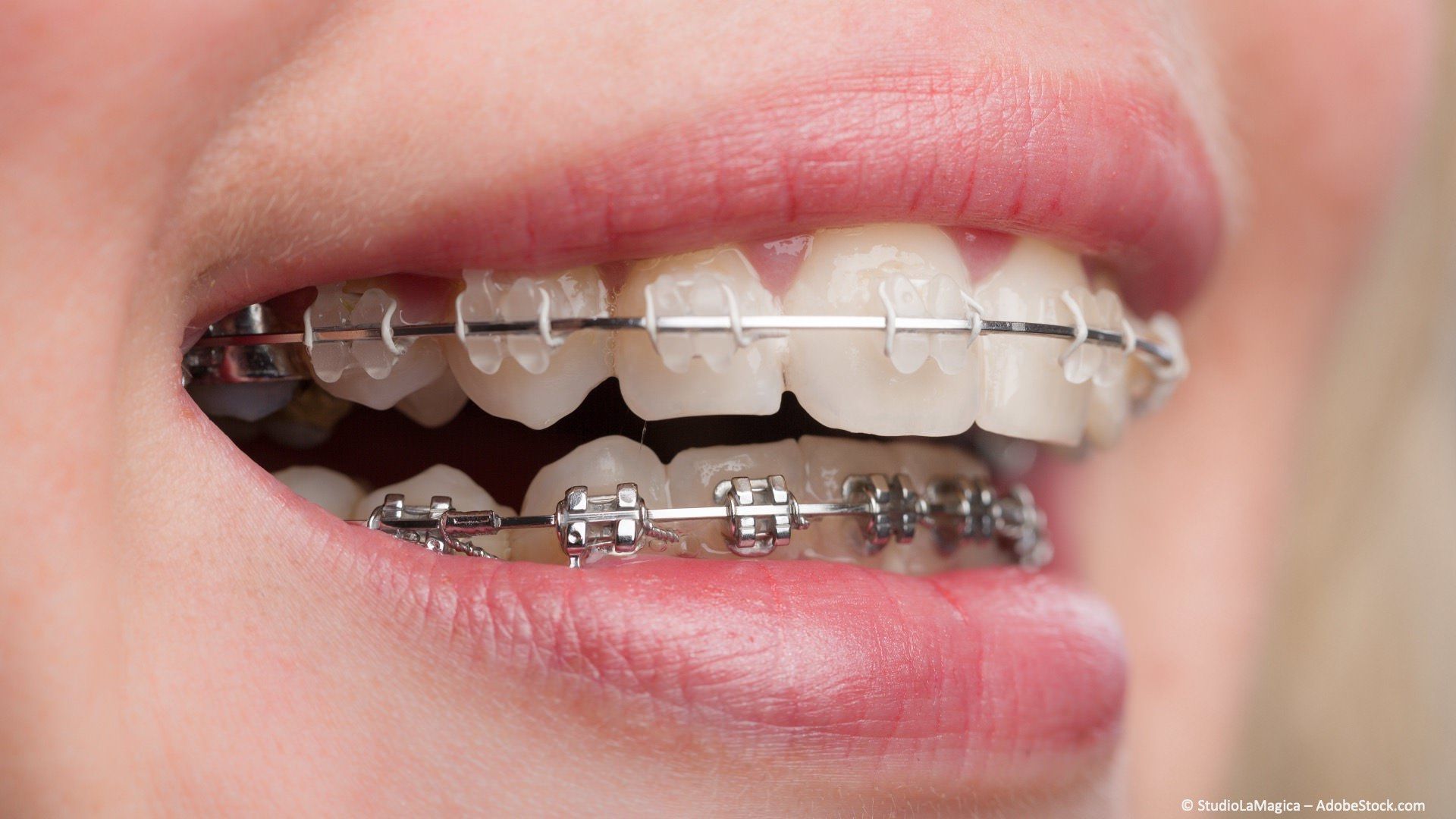 Festsitzende Zahnspangen mit transparenten oder Metall-Brackets