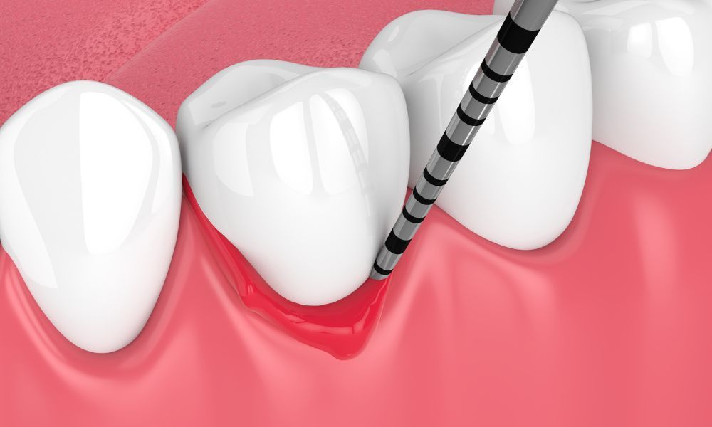 Periodontal Disease with Dental Implants