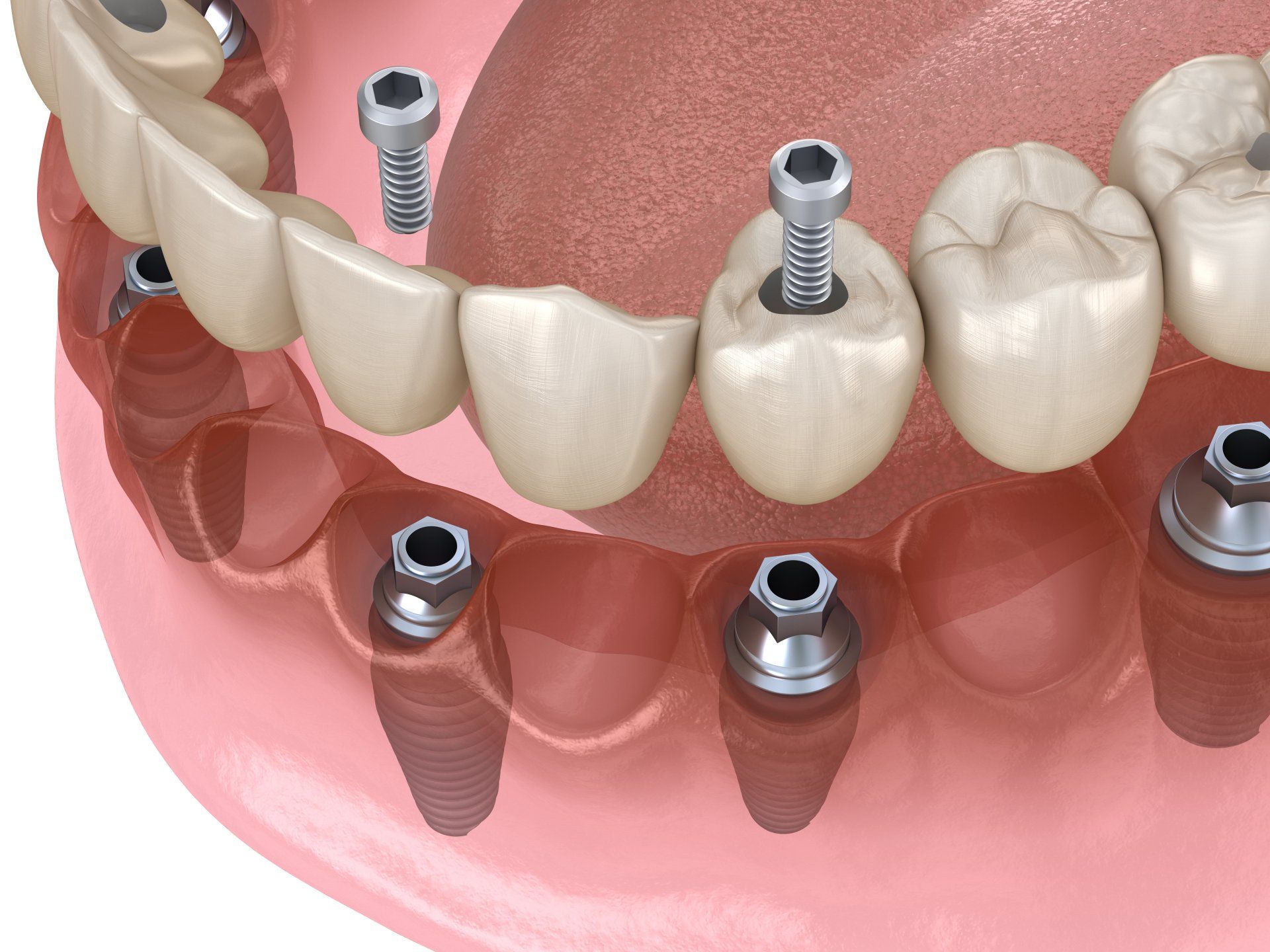 Dental Implants in Fort Collins