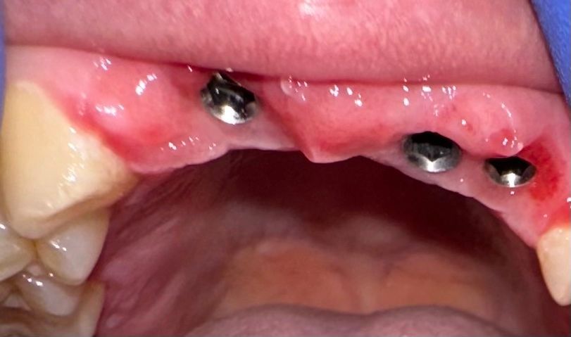 implantologia in paziente senza incisivi dentalmanoni