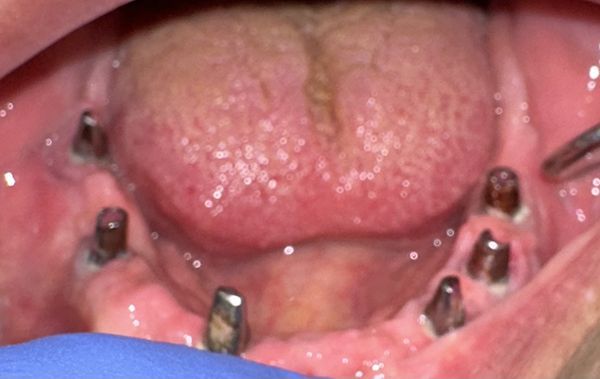 Pilastri su impianti dentali