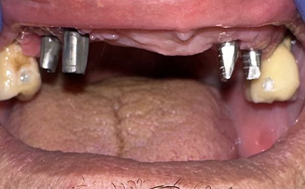 Pilastri su impianti dentali