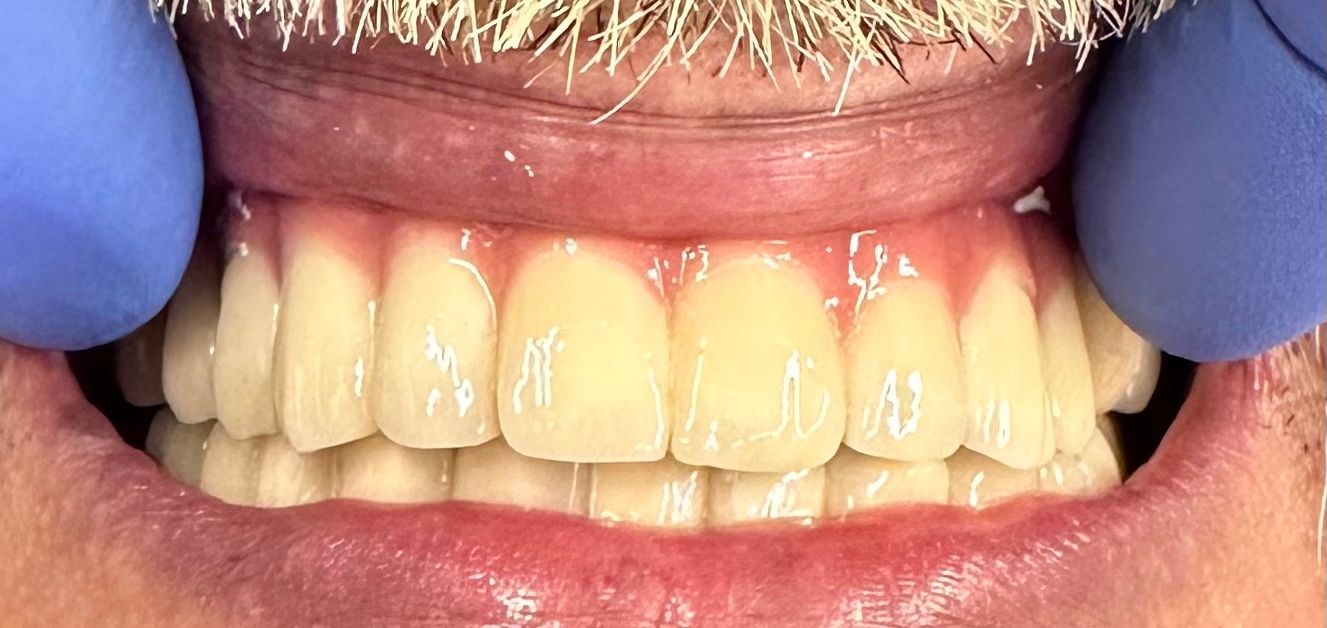 Ponte ceramica su impianti